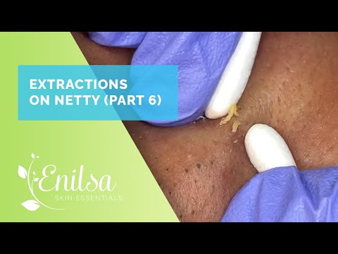 Blackhead Extractions on Netty - Sixth Treatment