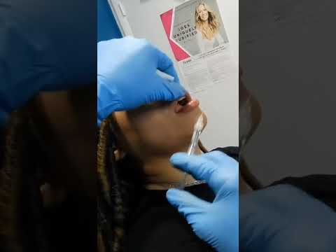 Master Swift Botox Filler Techniques for Upper and Lower Lips at Plantation Med Spa, Florida #shorts