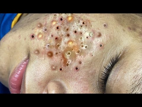 How to remove blackheads & whiteheads easily at home in Malayalam 💯