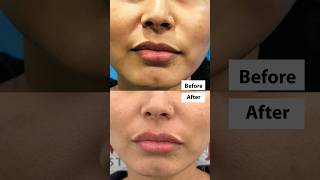 💋Improved Lip Shape by Fillers | Live Procedure #shortfeeds #lipfiller