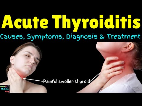 Acute Thyroiditis – Causes, Symptoms, Diagnosis and Treatment