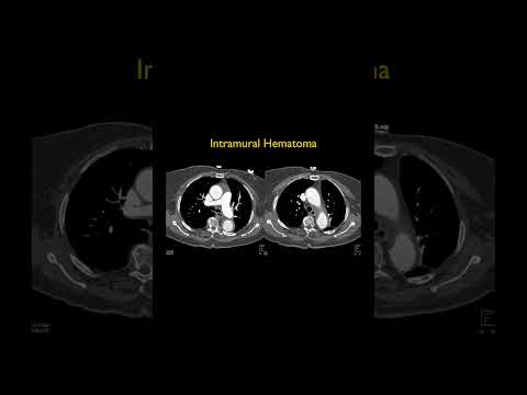 Intramural Hematoma