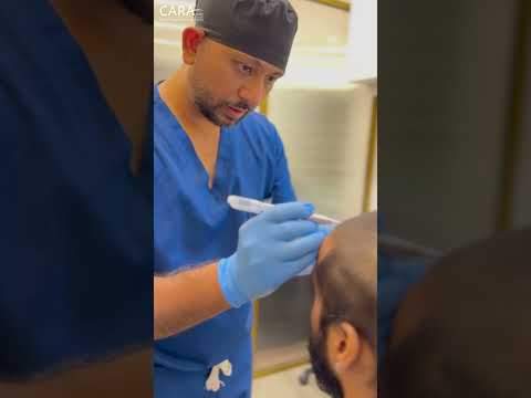 Best Cost of Hair Transplant Procedure | Trichometric Sapphire FUE | Cara Clinic