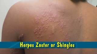 Herpes Zoster or Shingles