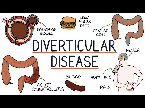 Understanding Diverticulosis and Diverticulitis