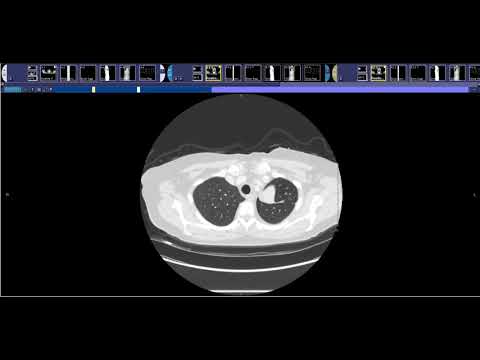 Basics of Oncologic Staging and Restaging / RECIST