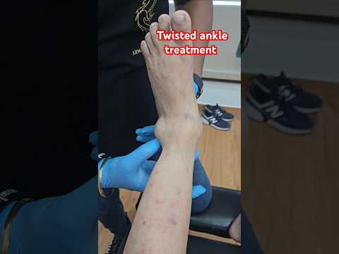 Twisted ankle treatment #drrajneeshkant #worldfamouschiropractor