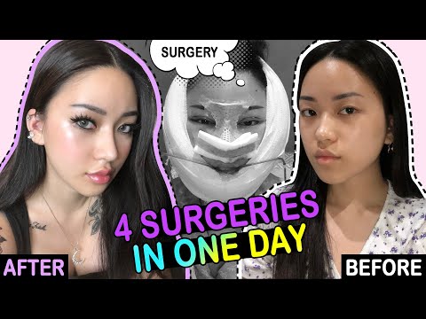 MY PLASTIC SURGERY IN KOREA PART2 │Recovery, Check-up, 2months post operation!