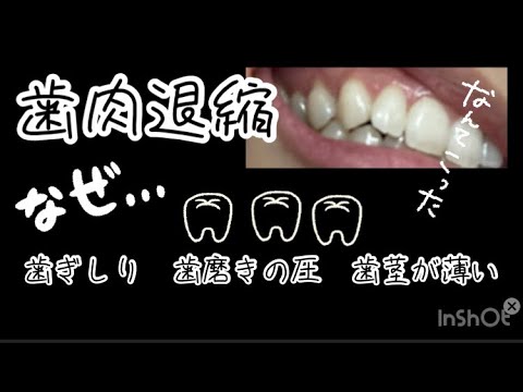 【歯肉退縮】30代　みんなの歯茎は大丈夫！？私…歯茎下りで悩んでます。