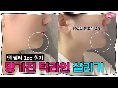 뭉툭하고 무너진 턱 필러로 살리기 (필러 2cc 솔직 후기)