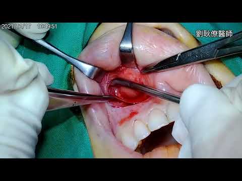 鼻翼囊腫 鼻唇囊腫 鼻齒槽囊腫 手術切除 nasolabial cyst nasoalveolar cyst, excision