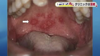 ヘルパンギーナが流行　前年の数を上回る　予防法は…うがい・石鹸で手洗い・ウイルスに負けない免疫力 (23/07/18 18:45)