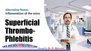 Superficial Thrombophlebitis : Causes, Diagnosis, Symptoms, Treatment, Prognosis