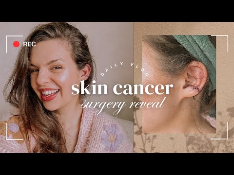 Skin cancer surgery reveal & skincare routine ✨ morning in the life