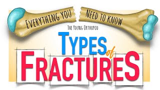 Bone Fracture: Types & Mechanisms | ANIMATION | Fracture classification | The Young Orthopod NEET PG