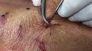 Reticular Vein Phlebectomy