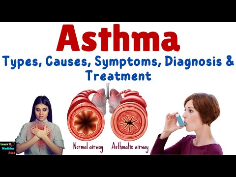 Asthma: Types, Causes, Symptoms, Diagnosis & Treatment