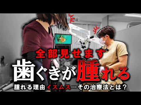 【 原因不明 】歯ぐきが腫れる理由はコレ！根っこの再治療　 #イスムス