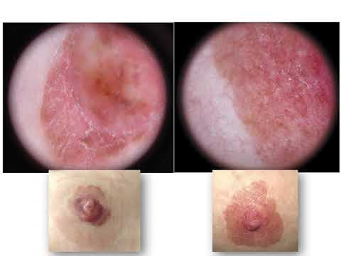 Mammary Paget's Disease - Dr. Zoe Apalla