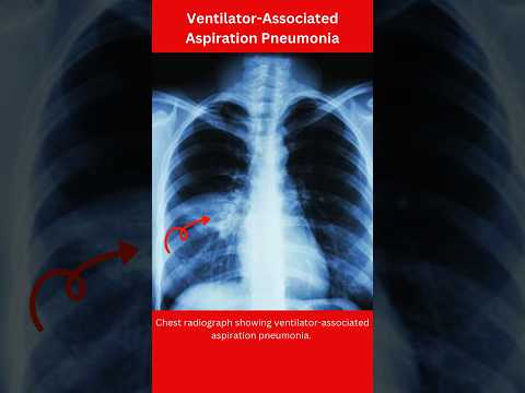 Ventilator associated aspiration pneumonia #pneumonia