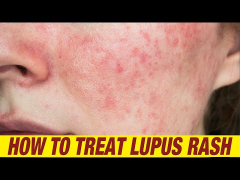 How To Cure Lupus | 5 Home Remedies for Lupus.