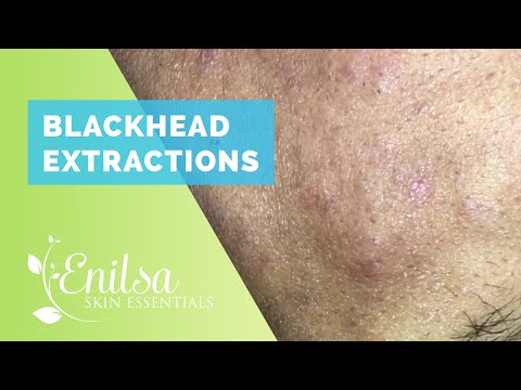 Blackheads Extractions on our Surprise Friend