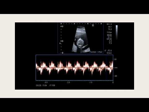 Heart beat of baby  #ultrasound #sonographer #health #pregnancy #fetusdevelopment