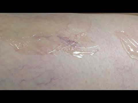 Treatment of Vascular Lesion - Transcutaneous Leg Vein by MedArt VariMed System