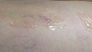 Treatment of Vascular Lesion - Transcutaneous Leg Vein by MedArt VariMed System