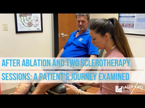 After Ablation and Two Sclerotherapy Sessions: A Patient's Journey Examined