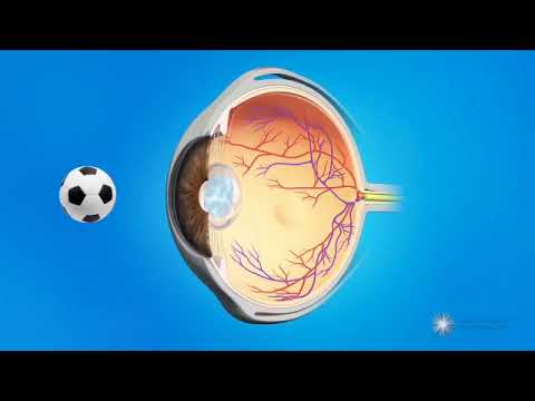 Capsulotomie au laser YAG  - Traitement laser de la cataracte secondaire