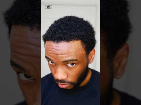 Hair Transplant Week 32👨🏾‍🦲‼️ Pt.2