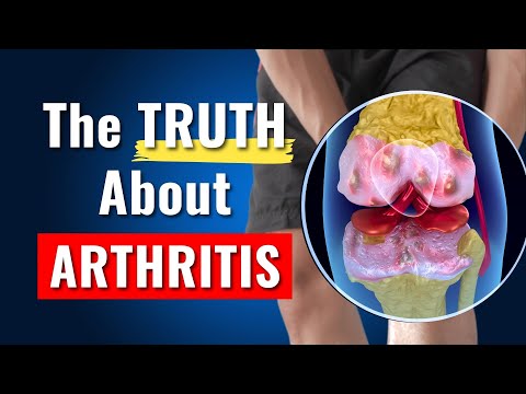 The Truth About Knee Arthritis - Top Myths Proven Wrong