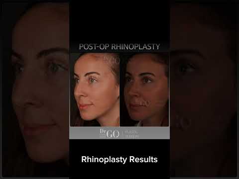 Before and after Rhinoplasty - Dr Guncel Ozturk #beforeandafter #rhinoplastyturkey #drgo