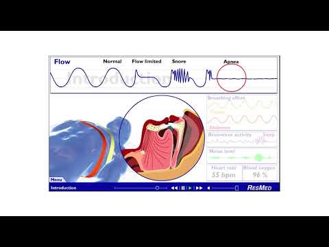 20240517 睡眠呼吸障礙＿AI 與 IoT 的應用