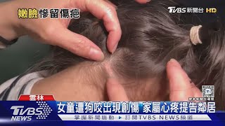 女童獨自走進鄰居家 遭秋田犬撕咬全身傷｜TVBS新聞 @TVBSNEWS01