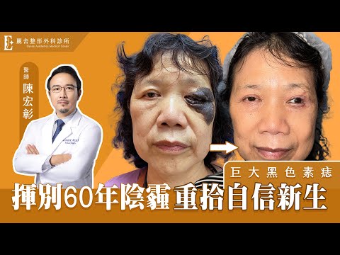 【巨大黑色素痣移除全記錄】醫美診所醫師只愛錢？這位超乎你想像！陳宏彰醫師｜麗舍整形外科