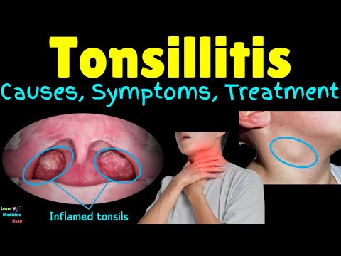 Tonsillitis – Causes, Symptoms, Diagnosis, Treatment, Complications & Prevention