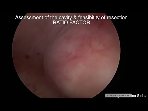 Submucous myoma Resection Dr Rooma Sinha Apollo hospitals