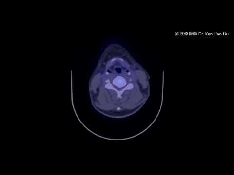 甲狀腺癌 正子電腦斷層掃描 Thyroid cancer PET CT scan