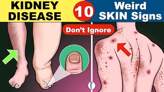 Skin signs of Kidney Disease | Chronic Kidney Disease | Kidney Failure Symptoms | CKD