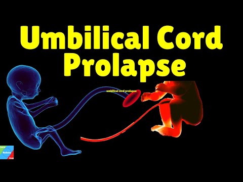 Umbilical Cord Prolapse | Cord Prolapse – Causes, Symptoms & Management