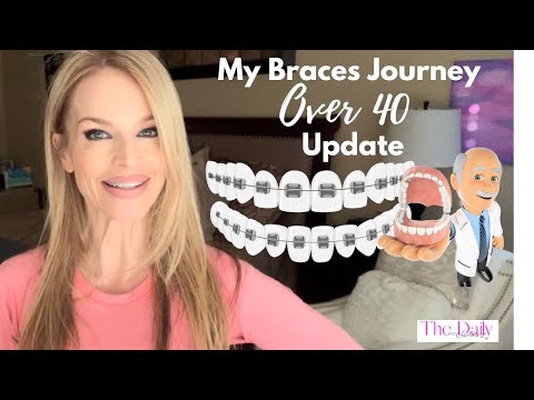 Braces Over 40 Journey UPDATE-What I Don't like About Braces and My Suggestions.