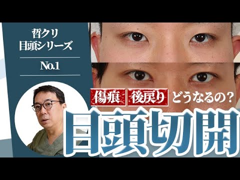 【目頭切開】動画で分かる後戻りや傷跡は？絶対NGな方法まで解説！哲クリ目頭シリーズNo.1