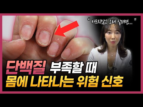 아프지않고 오래 살려면 걷기 대신 이렇게만 하세요 | 단백질이 부족할 때 몸에서 보내는 신호 | 노화의 원인, 근감소증 예방