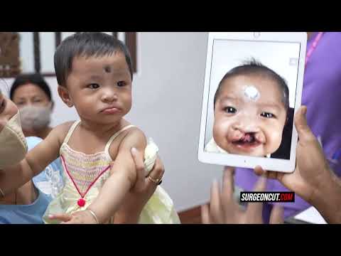 Cute Baby’s Journey from Northeast India for Palate Surgery by Dr. Sunil Richardson