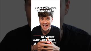 NEW HAIR LOSS TREATMENT?! (2dDR) #hairloss #hairlosstreatment