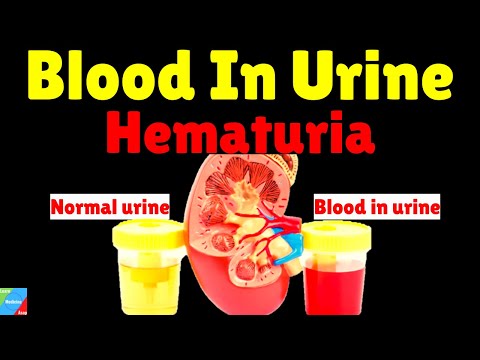 Blood In Urine (Hematuria) - Causes, Symptoms, Diagnosis, Treatment & Prevention