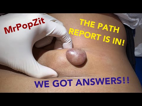 The results are in, the path report is back, and what an amazing rare growth!