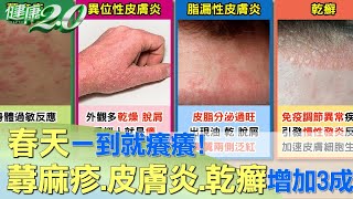 春天一到就癢癢！ 蕁麻疹、皮膚炎、乾癬增加3成 健康2.0